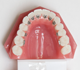 歯の舌側からの矯正